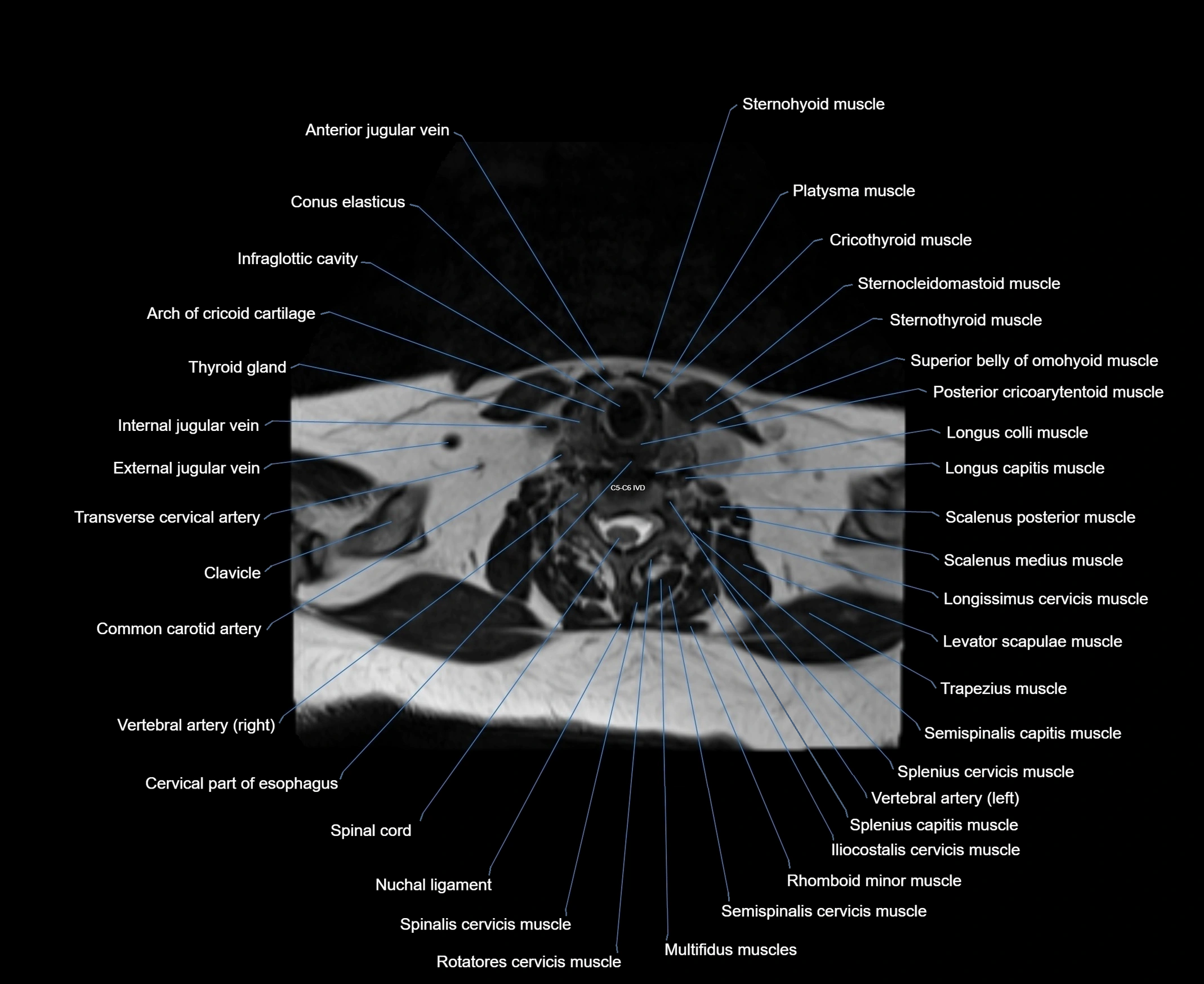 MRI Neck 3D labelled cross section anatomy axial 3t image-00001-00067.webp